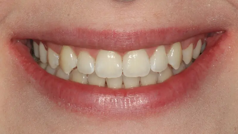 Clear Aligner Therapie 8