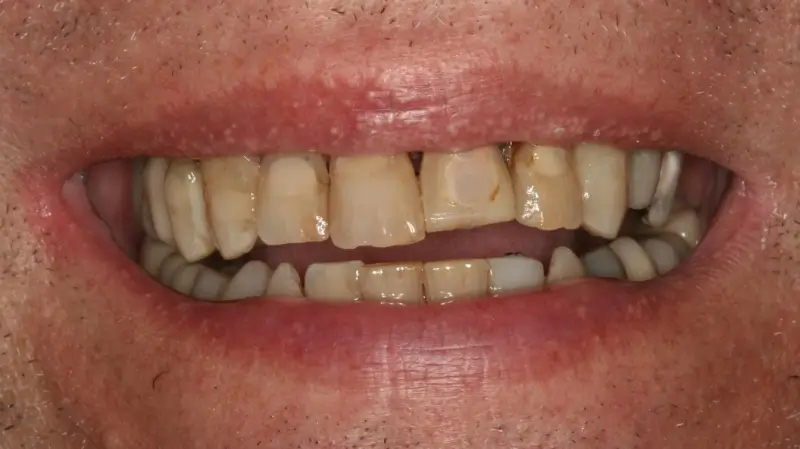Kronen und Veneers 81